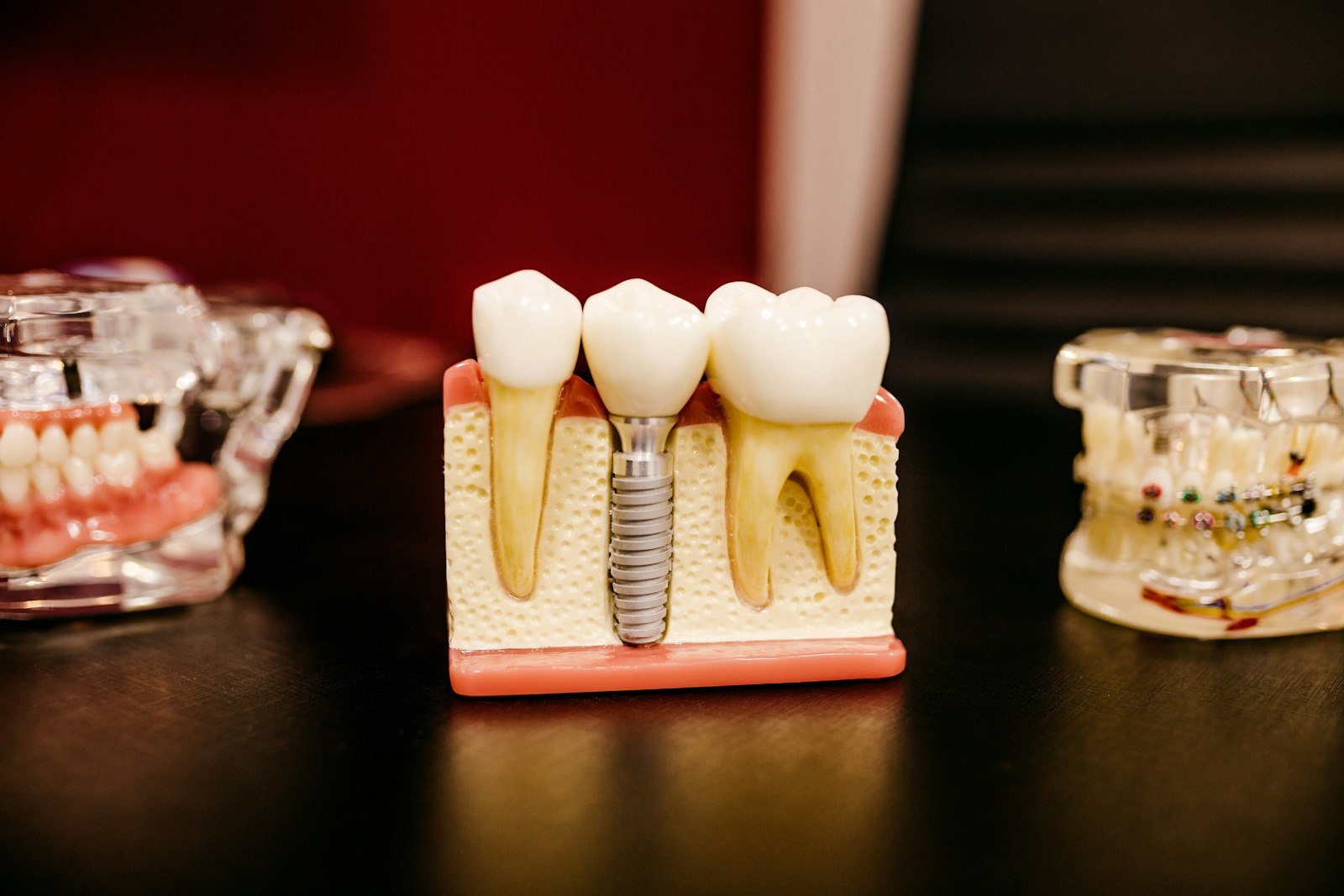 http://Dental%20implant%20model%20used%20in%20patient%20consultations